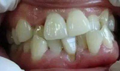 成人牙齿有虫子视频,警惕口腔健康隐患