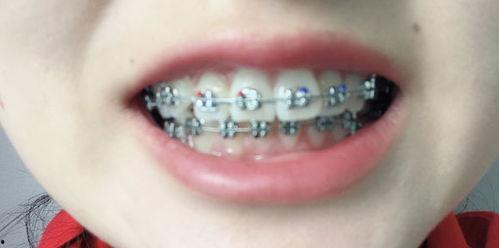 成人牙齿有虫子视频,警惕口腔健康隐患