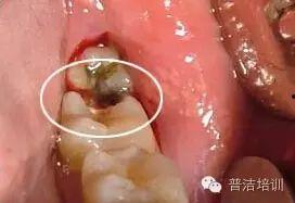 成人牙齿有虫子视频,警惕口腔健康隐患