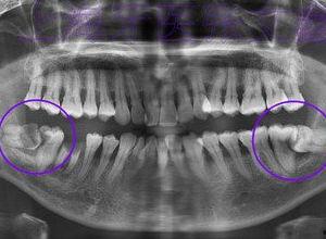 评测成人磨牙神器的视频,视频评测带你全面了解