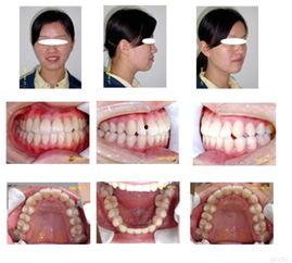 评测成人磨牙神器的视频,视频评测带你全面了解