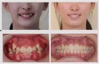 成人脱牙的正确方法视频,成人脱牙操作步骤详解