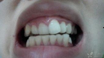 成人脱牙的正确方法视频,成人脱牙操作步骤详解